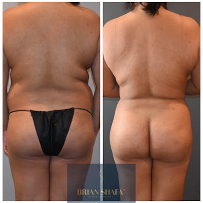 Brazilian Butt Lift Before & After Photos - Patient 146287405 - Image 1