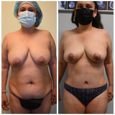 Mommy Makeover Before & After Gallery - Patient 146287406 - Image 1