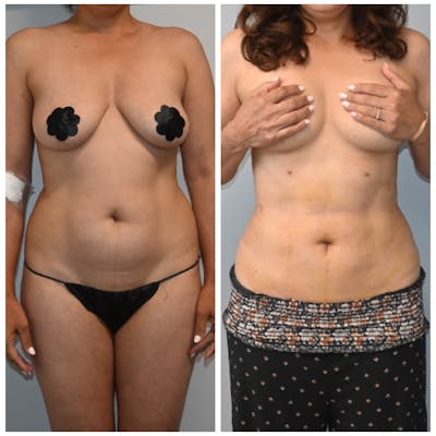 High-Def Liposuction  Before & After Gallery - Patient 146287407 - Image 1