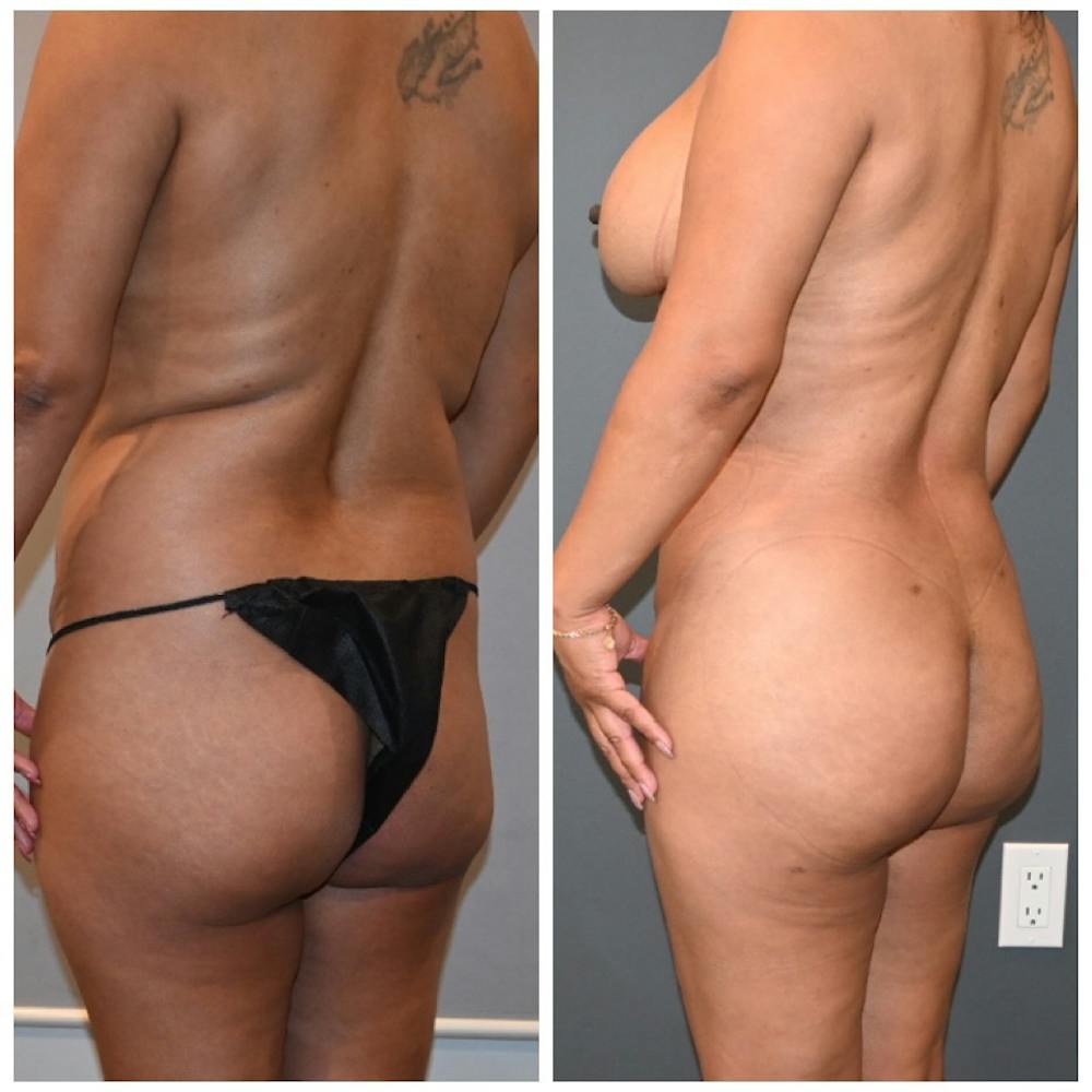 Liposuction Before & After Photos - Patient 146287409 - Image 4