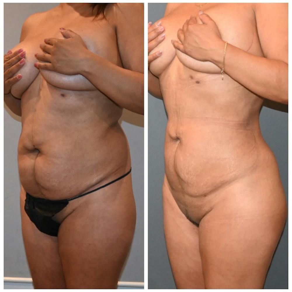 Liposuction Before & After Photos - Patient 146287409 - Image 3