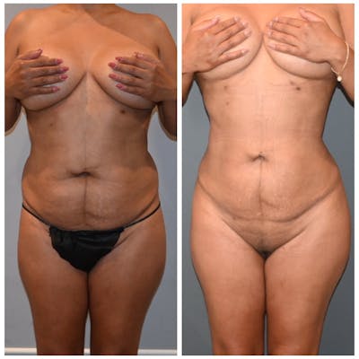 Liposuction Before & After Photos - Patient 146287409 - Image 2