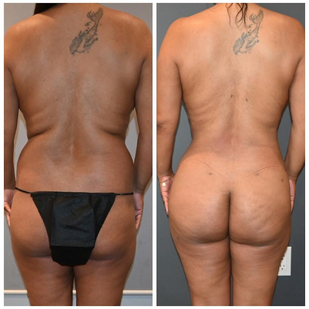 Liposuction Before & After Photos - Patient 146287409 - Image 1
