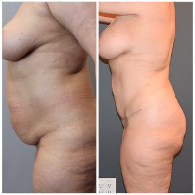 Liposuction Before & After Gallery - Patient 146287410 - Image 1