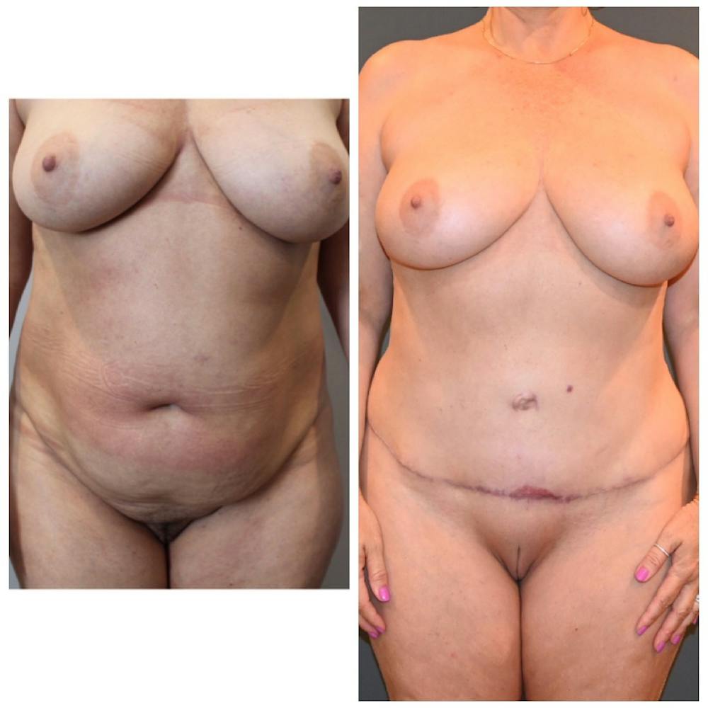 Liposuction Before & After Gallery - Patient 146287410 - Image 2