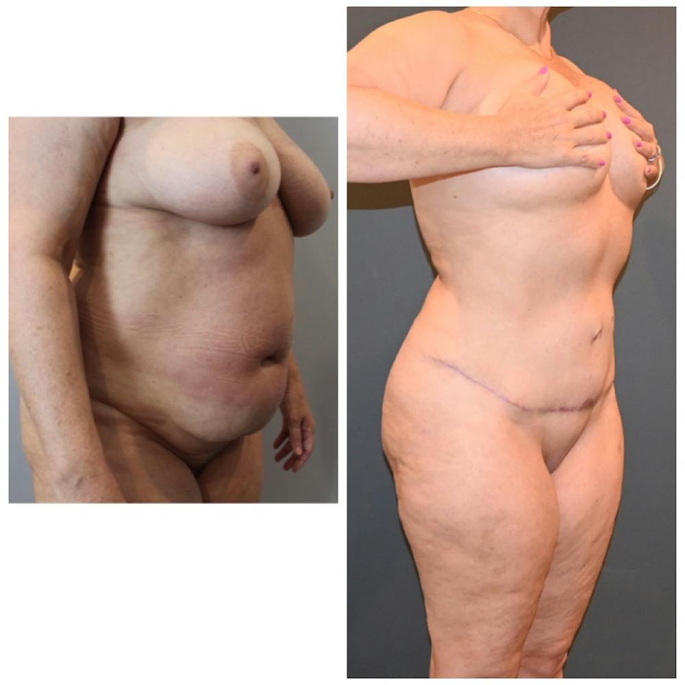Liposuction Before & After Gallery - Patient 146287410 - Image 3