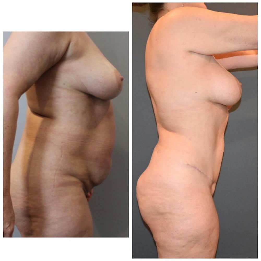 Liposuction Before & After Gallery - Patient 146287410 - Image 4