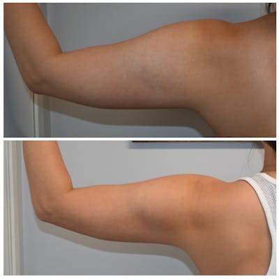 Liposuction Before & After Gallery - Patient 146287411 - Image 1