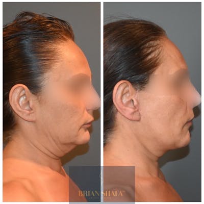 Facelift/Necklift Before & After Photos - Patient 146287412 - Image 1