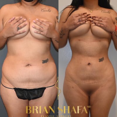 Lipo 360 Before & After Photos - Patient 130517 - Image 1