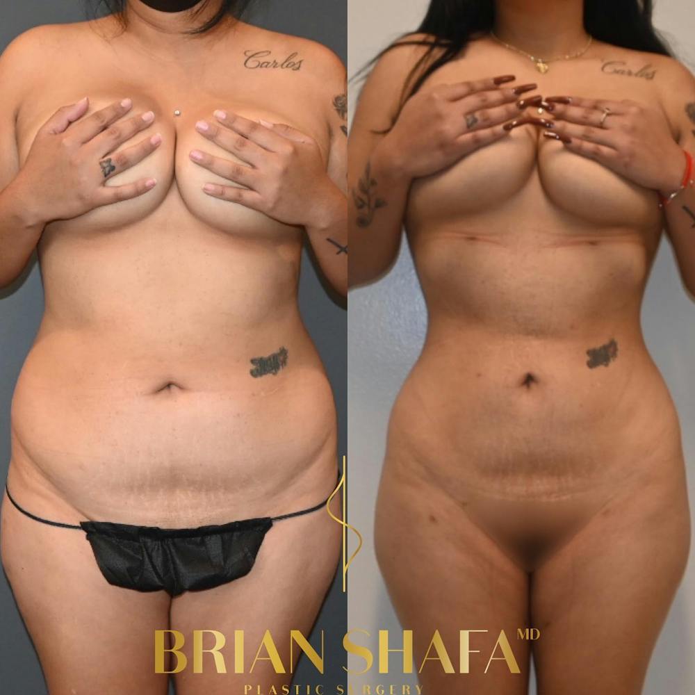 Lipo 360 Before & After Gallery - Patient 130517 - Image 1