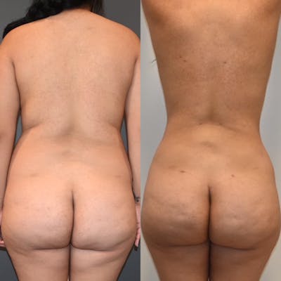 Lipo 360 Before & After Gallery - Patient 130517 - Image 2
