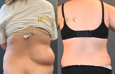 Lipoma Removal Before & After Photos - Patient 146778858 - Image 1