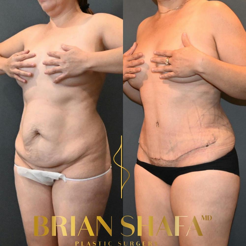 High-Def Liposuction  Before & After Gallery - Patient 146778863 - Image 1