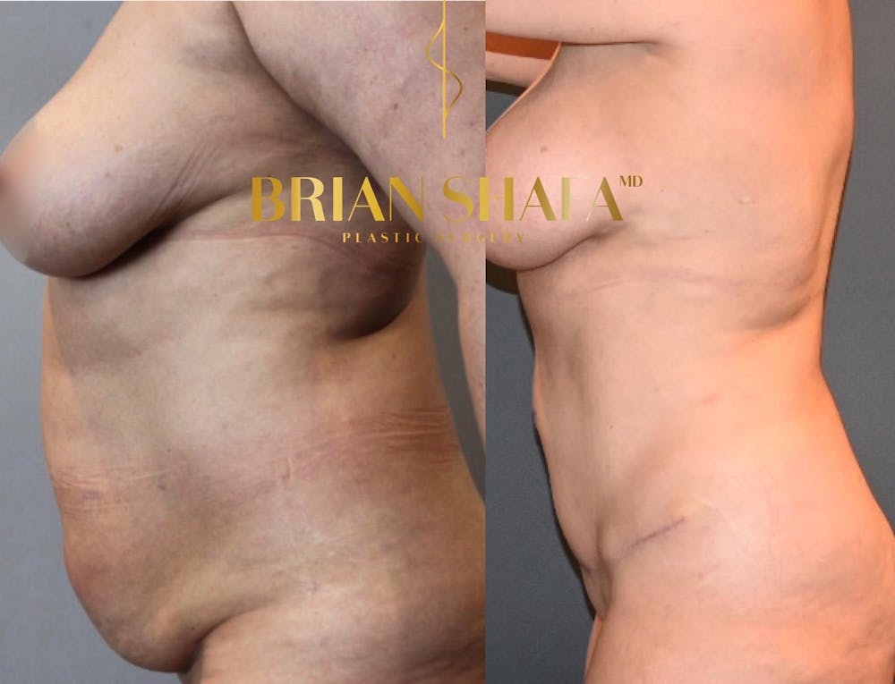 Tummy Tuck (Abdominoplasty) Before & After Photos - Patient 146778865 - Image 2