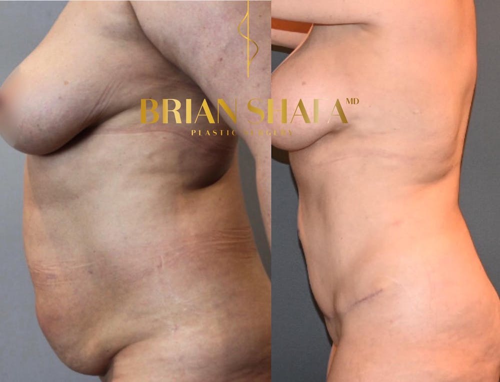 Tummy Tuck/ Abdominoplasty Before & After Gallery - Patient 146778865 - Image 2