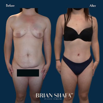 Tummy Tuck (Abdominoplasty) Before & After Photos - Patient 146778868 - Image 1