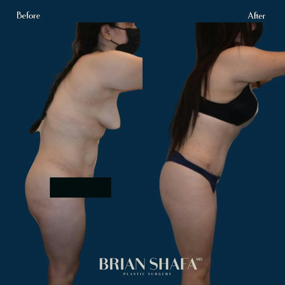 Tummy Tuck (Abdominoplasty) Before & After Photos - Patient 146778868 - Image 2