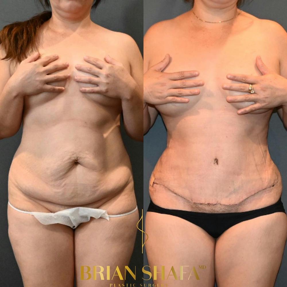 Tummy Tuck (Abdominoplasty) Before & After Photos - Patient 146778872 - Image 1