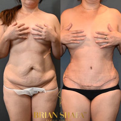 Tummy Tuck (Abdominoplasty) Before & After Photos - Patient 146778872 - Image 1