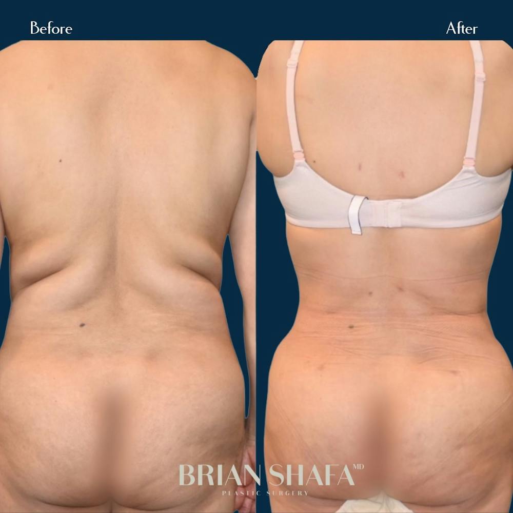 Liposuction Before & After Photos - Patient 146778885 - Image 1