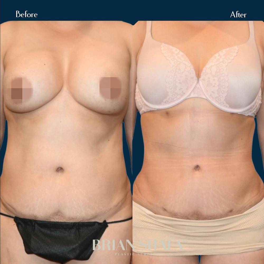 Liposuction Before & After Gallery - Patient 146778885 - Image 2