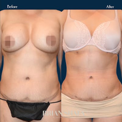 Liposuction Before & After Gallery - Patient 146778885 - Image 2