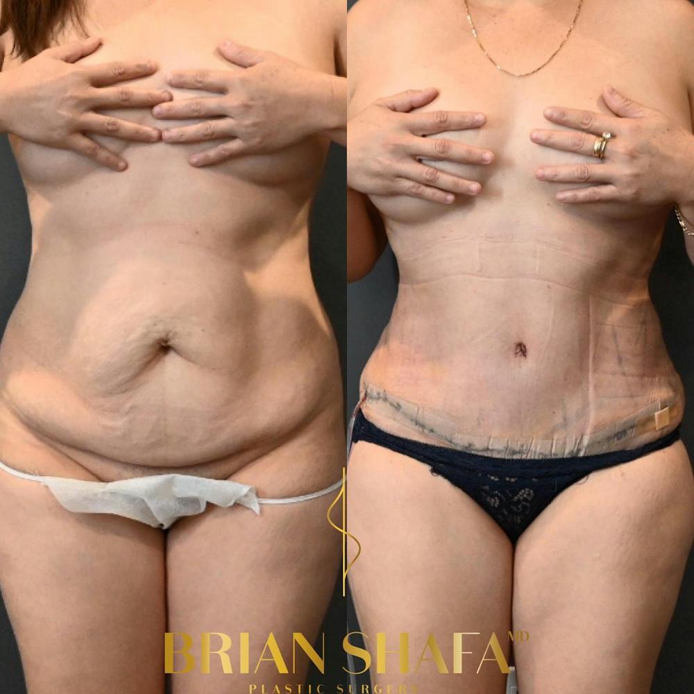 Tummy Tuck/ Abdominoplasty Before & After Gallery - Patient 146778893 - Image 1
