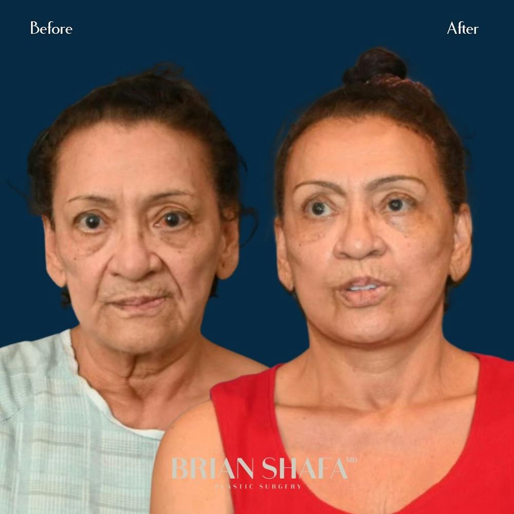 Facelift/Necklift Before & After Gallery - Patient 146778899 - Image 1