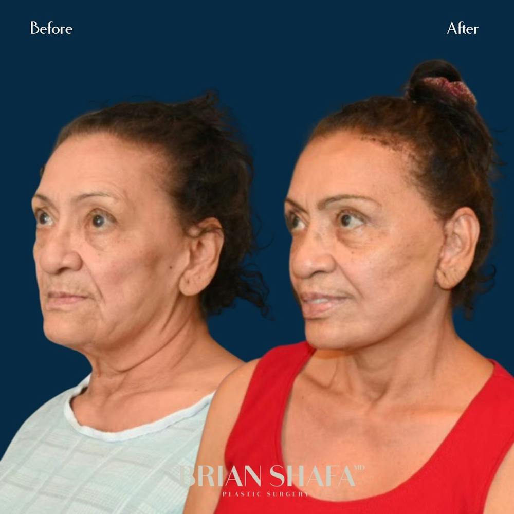 Facelift/Necklift Before & After Gallery - Patient 146778899 - Image 2