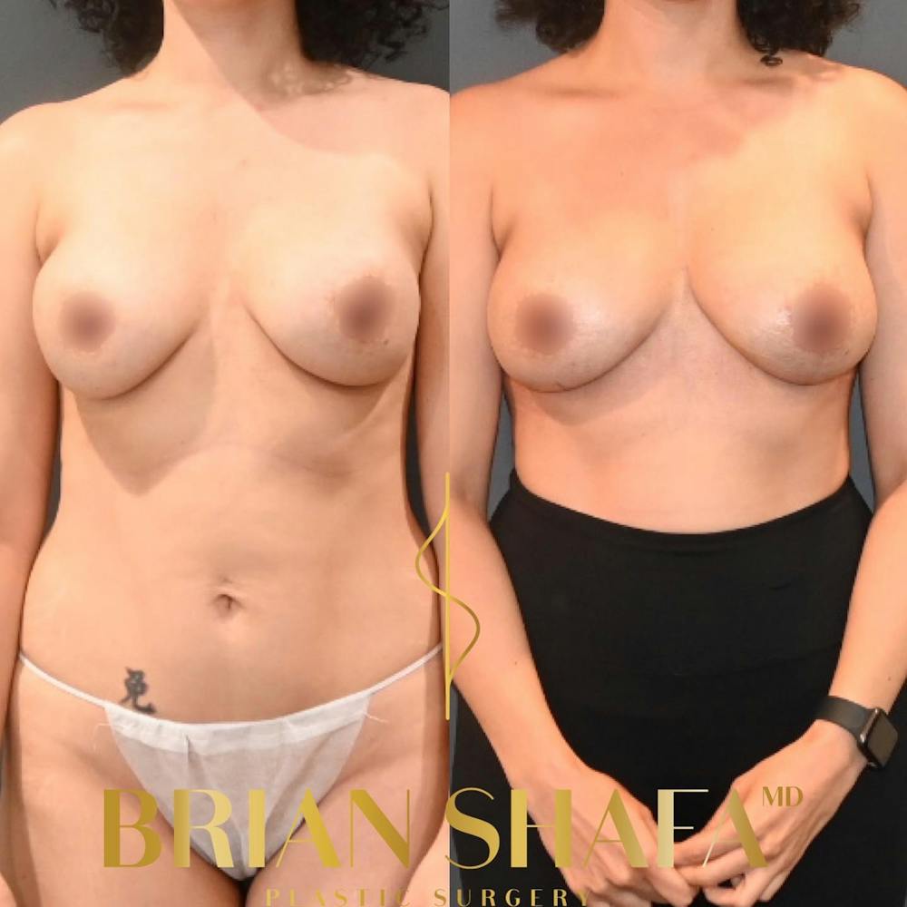 Breast Revision Before & After Gallery - Patient 149031069 - Image 1