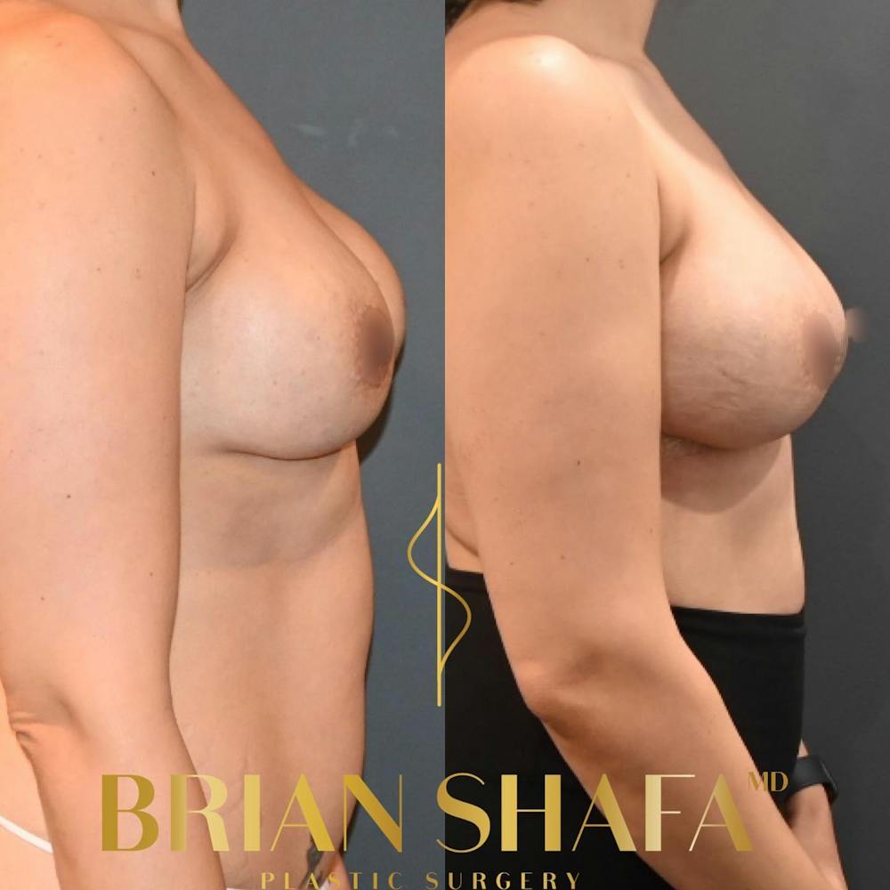 Breast Revision Before & After Gallery - Patient 149031069 - Image 2