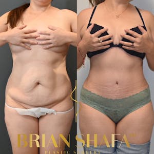 Mommy makeover procedure before and after