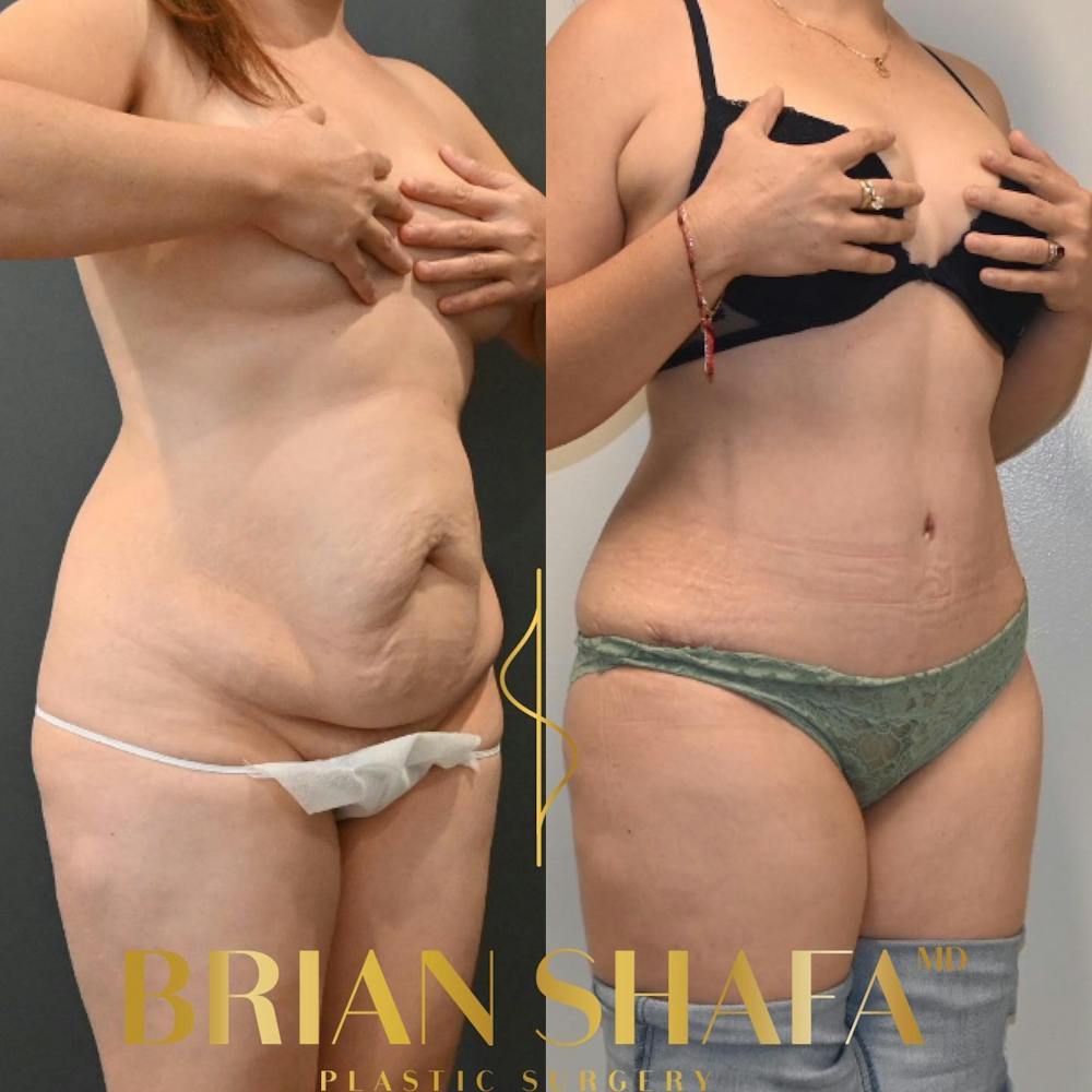 Tummy Tuck (Abdominoplasty) Before & After Photos - Patient 149031079 - Image 2