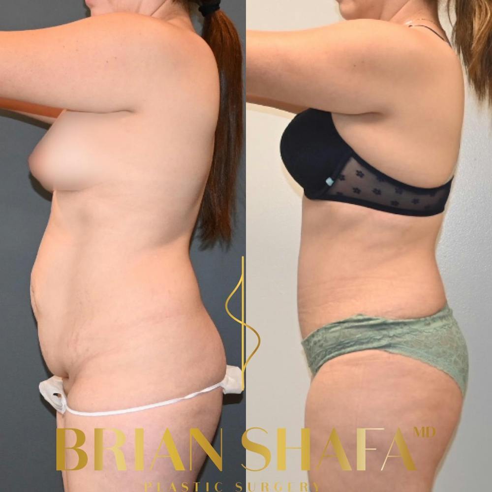 Tummy Tuck (Abdominoplasty) Before & After Photos - Patient 149031079 - Image 3