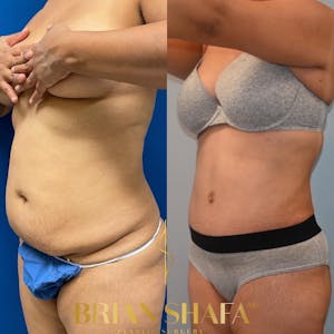 Mommy makeover procedure before and after