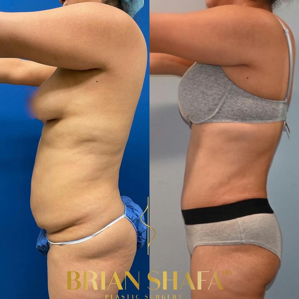 Tummy Tuck (Abdominoplasty) Before & After Photos - Patient 149031085 - Image 2
