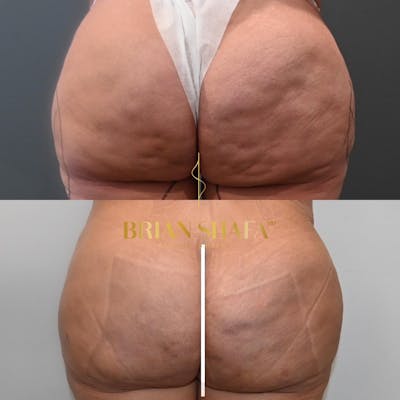 Avéli™ Cellulite Reduction Before & After Photos - Patient 149031114 - Image 1