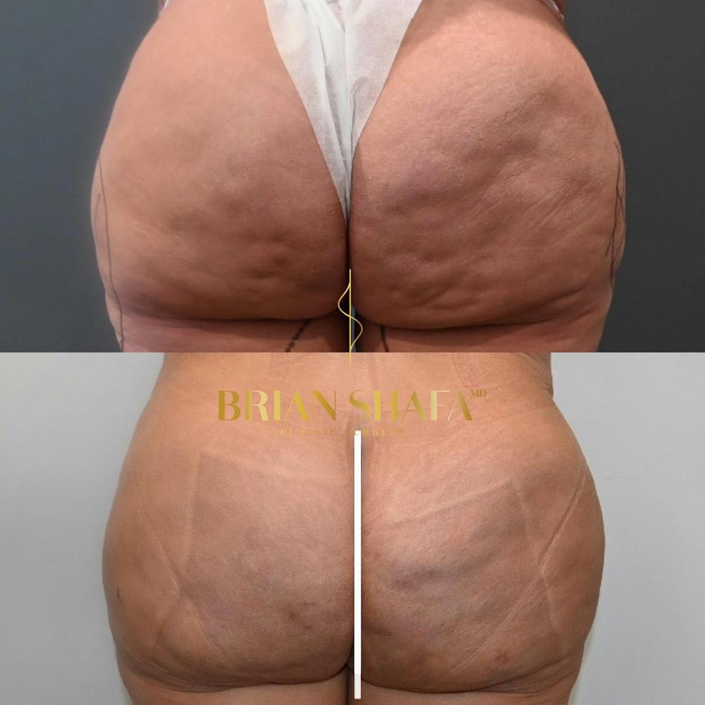 Cellulite Reduction Before & After Gallery - Patient 149031114 - Image 1