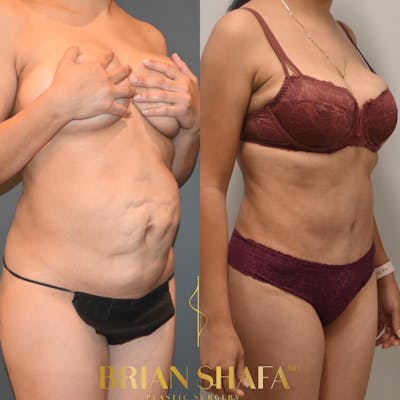 Diastasis Recti Before & After Photos - Patient 149031150 - Image 1