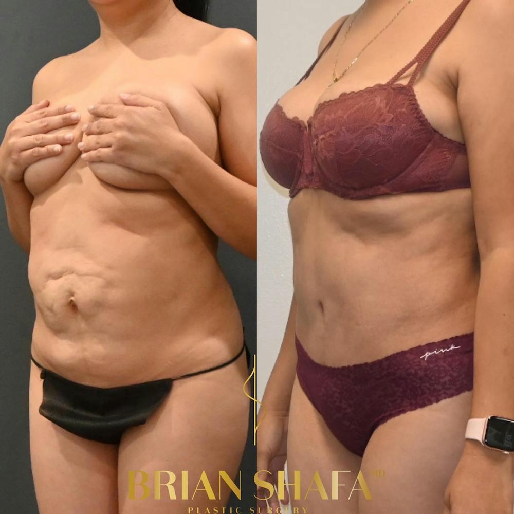 Diastasis Recti Before & After Photos - Patient 149031150 - Image 2