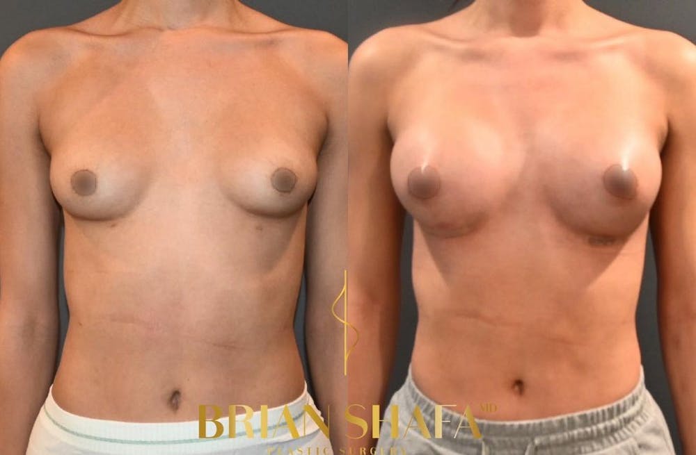 Transgender Breast Augmentation Before & After Gallery - Patient 149031163 - Image 1