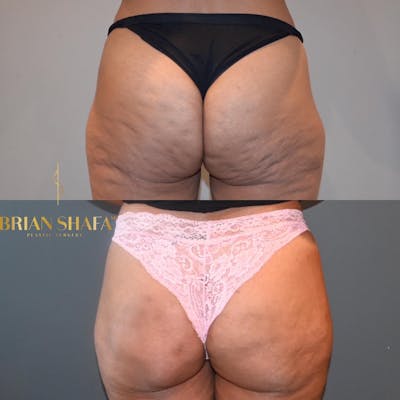 Avéli™ Cellulite Reduction Before & After Photos - Patient 149031184 - Image 1