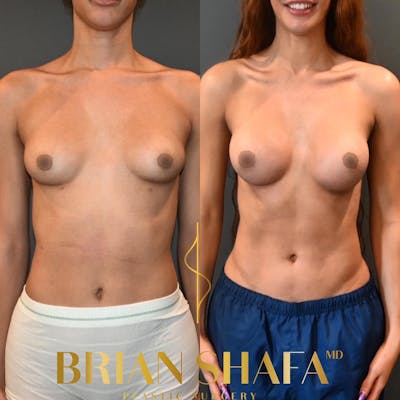 Transgender Breast Augmentation Before & After Photos - Patient 149236737 - Image 1