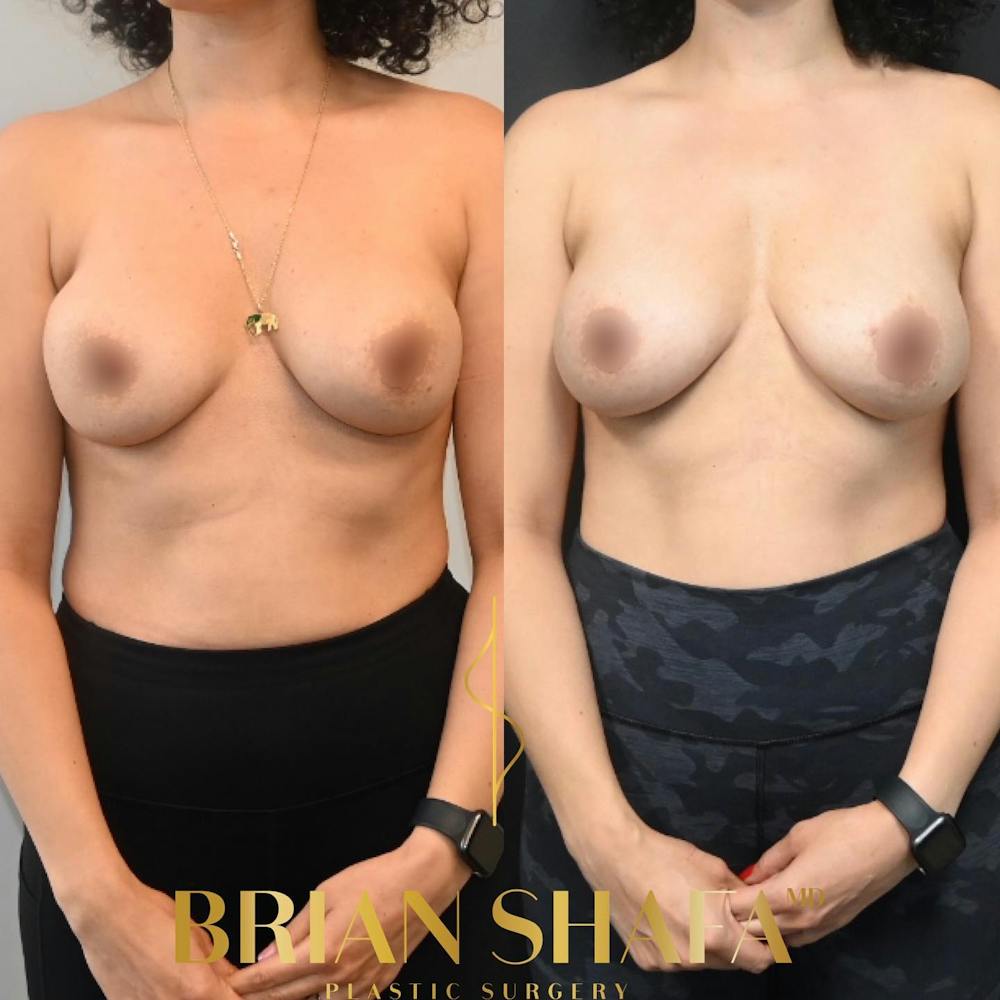 Breast Revision Before & After Gallery - Patient 149236738 - Image 2