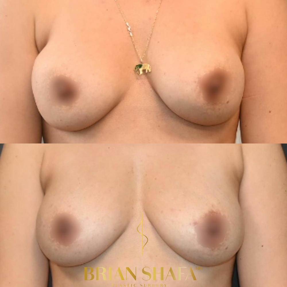 Breast Revision Before & After Gallery - Patient 149236738 - Image 1