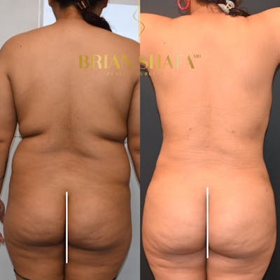 Brazilian Butt Lift Before & After Photos - Patient 149236743 - Image 1