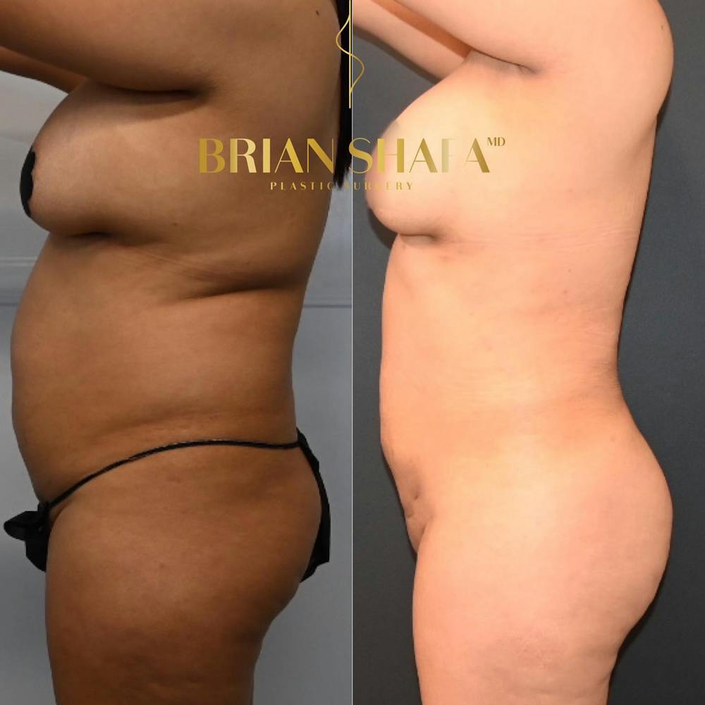 Brazilian Butt Lift Before & After Photos - Patient 149236743 - Image 2