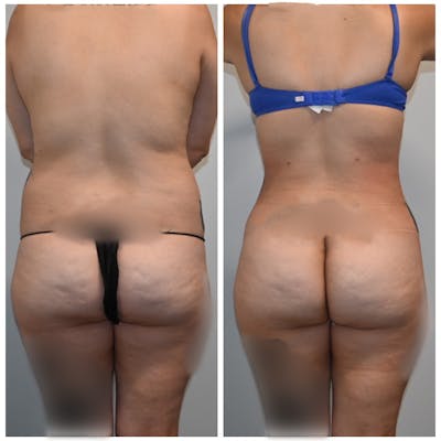 Brazilian Butt Lift Before & After Photos - Patient 149342265 - Image 1