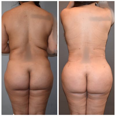 Brazilian Butt Lift Before & After Photos - Patient 149342266 - Image 1